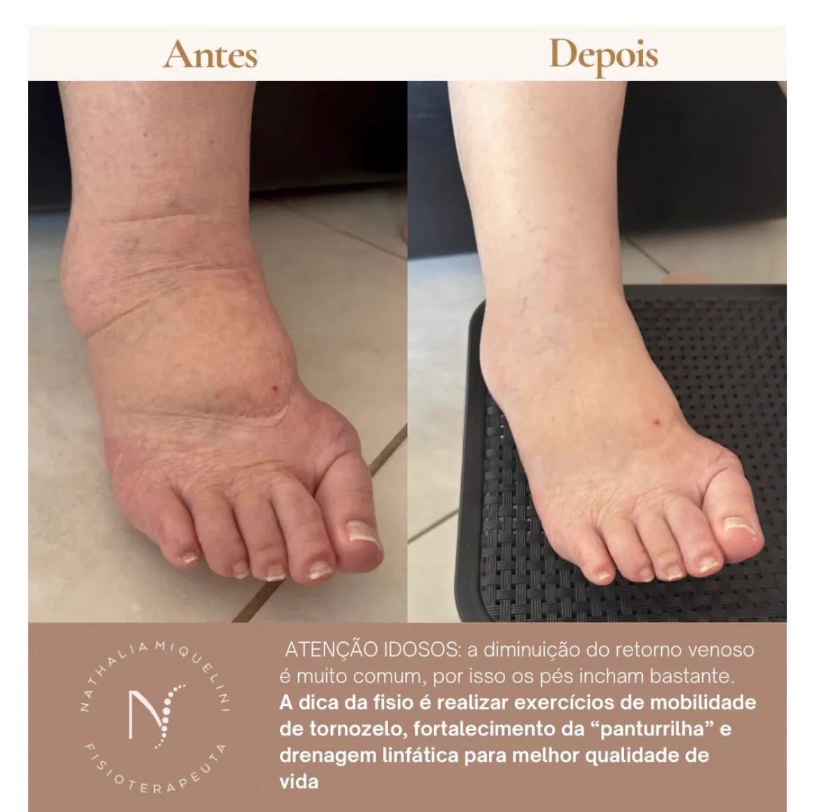 Antes e depois: redução do inchaço no pé e tornozelo